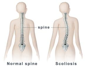 large spine scoliosis