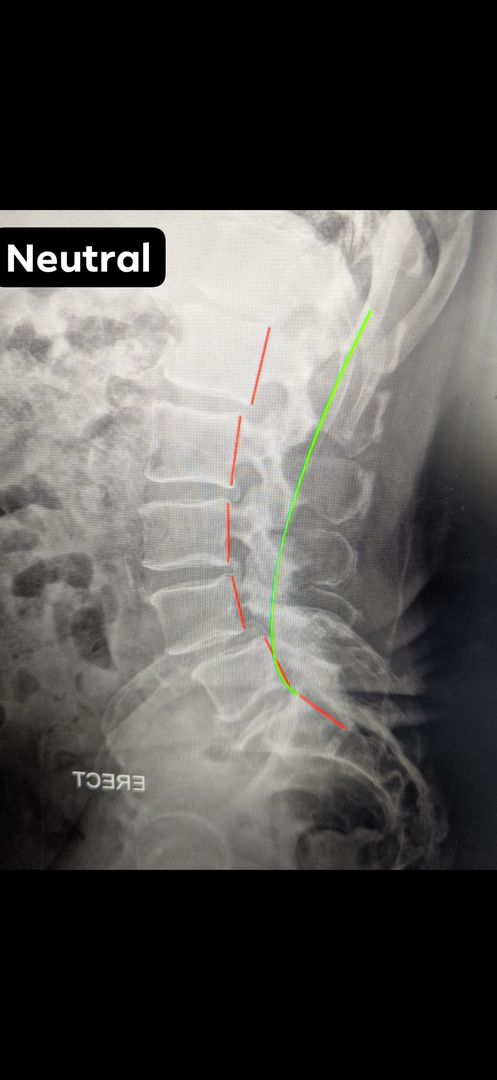 Standing lateral lumbar radiograph labeled Neutral with spinal alignment analysis lines