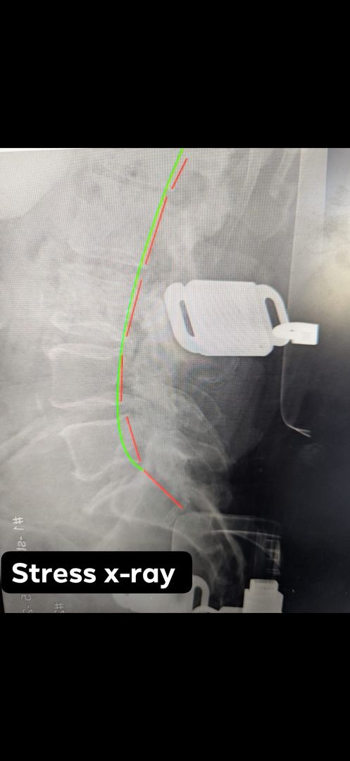 Lumbar stress radiograph with embedded alignment lines and Stress label