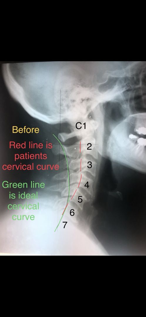 Lateral cervical radiograph labeled Before with cervical alignment measurement lines