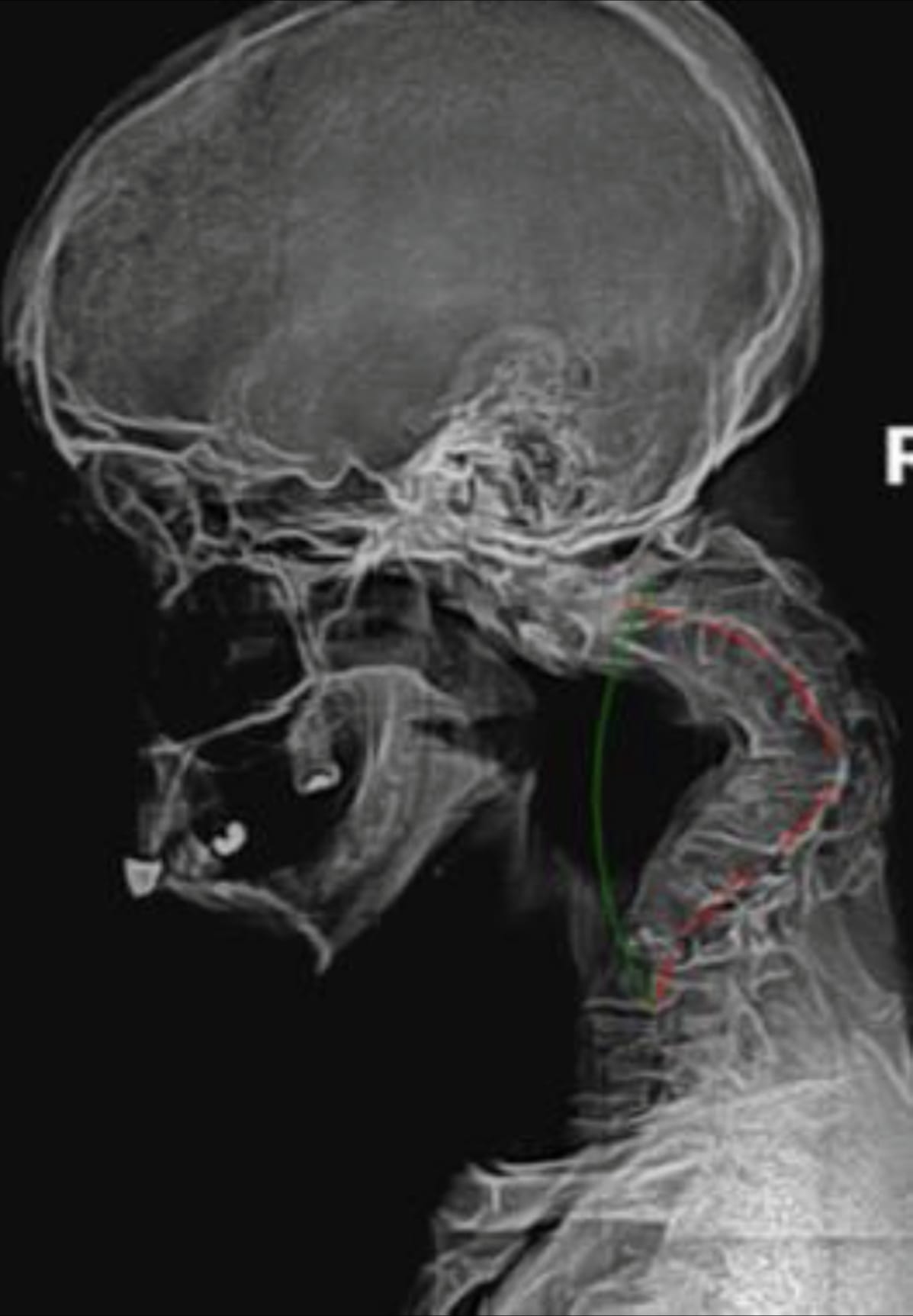 Lateral cervical radiograph with green ideal-curve and red patient-curve alignment lines