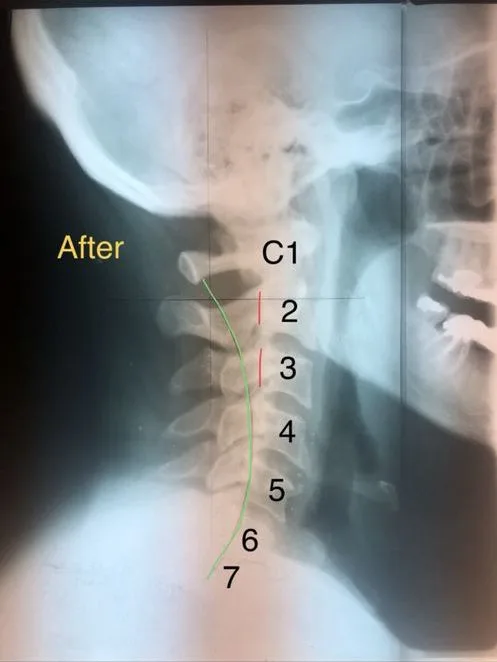 Individual case — cervical X-ray showing improved cervical curve