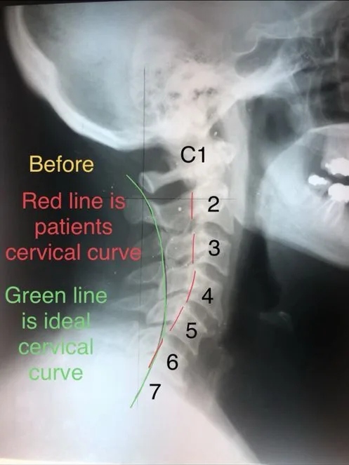 Individual case — cervical X-ray showing reduced cervical curve