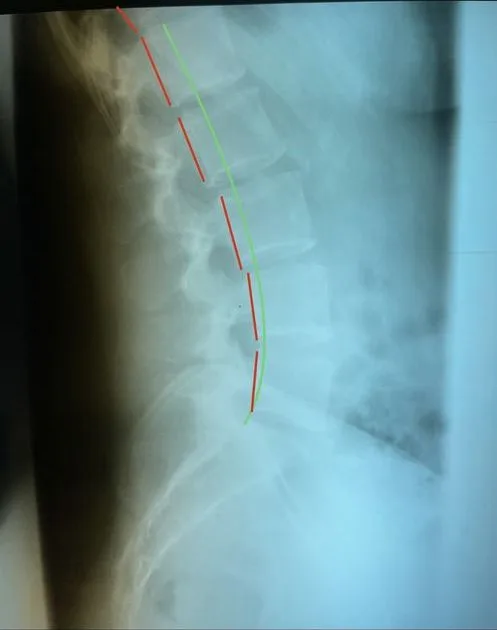 Lateral lumbar X-ray after care, showing improved lumbar lordosis
