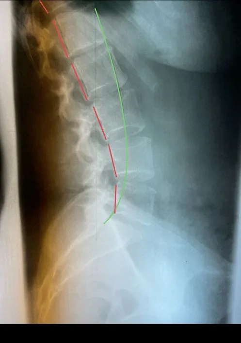 Lateral lumbar X-ray before care, showing reduced lumbar lordosis