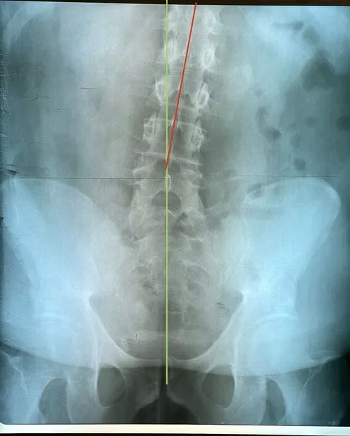 Standing spinal radiograph used to illustrate how the Cobb angle is measured
