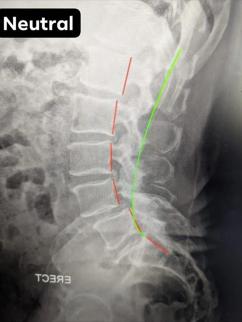 Neutral standing X-ray of a lumbar spondylolisthesis