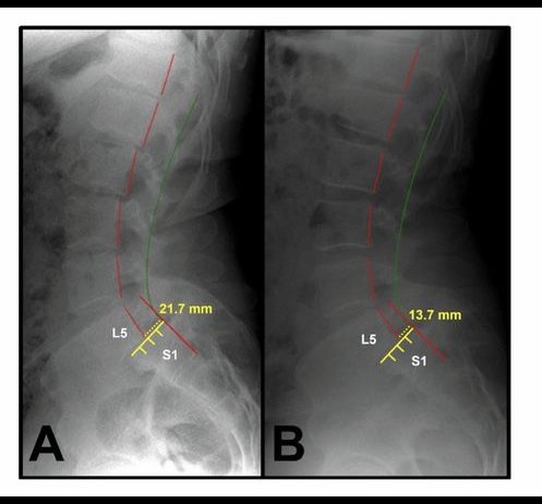 Figure 6 from Fedorchuk et al. 2026: two neutral lateral lumbar X-rays of a 40-year-old man with L5 on S1 anterolisthesis, panel A before treatment measuring 21.7 mm and panel B after 36 visits measuring 13.7 mm