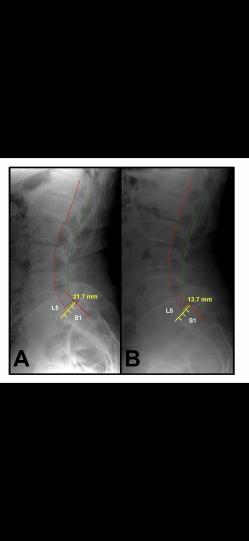 Spondylolisthesis before and after X-ray comparison