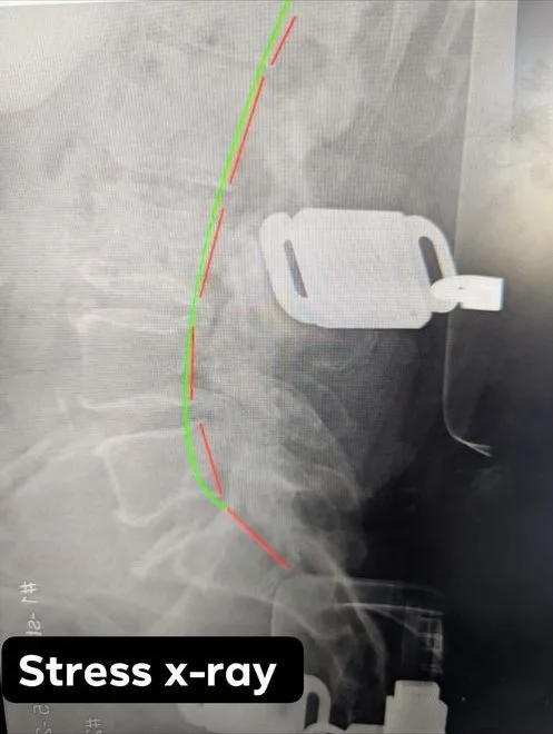 Stress (flexion-extension) X-ray used to assess segmental motion