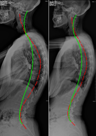 Chiropractic Biophysics Pre Post X-Ray Analysis