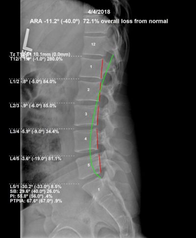 Chiropractic Biophysics Optimus Spine & Posture analysis