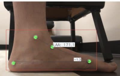 Custom Foot Orthotic Analysis
